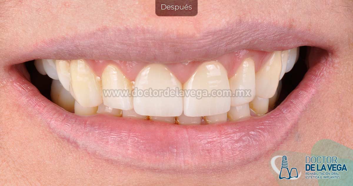 carillas dentales archivos - Clinica Dental Cuadrado